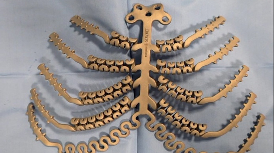 A Modena sterno in titanio su paziente affetta da carcinoma