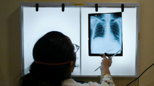 Hausse des nouveaux cas de tuberculose, une premi&egrave;re en plus de 20 ans (OMS)